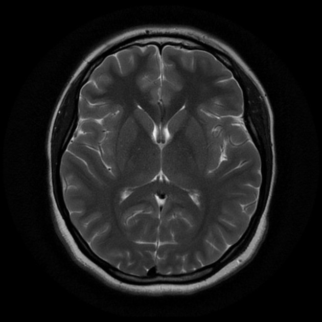 МРТ снимок здорового головного мозга